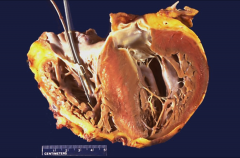 Gross appearance of heart in hypertrophic cardiomyopathy.