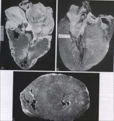 Gross appearance of heart in hypertrophic cardiomyopathy.
