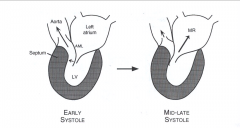 *In the asymmetric form-- transient systolic obstruction in 1/3 of the cases.

*Hypertrophic cardiomyopathy with outflow obstruction
-The thickened upper interventricular septum causes transient LV outflow obstruction d/t abnormal motion of the...