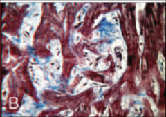 HCM. Trichrome stain (collagen) myofiber disarray.