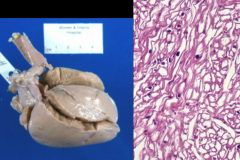 RCM: heart in glycogen storage disease Type II (Pompe’s disease).