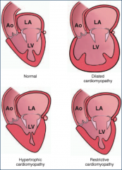 *Dilated cardiomyopathy (90%):
-LV chamber enlargement / minimal hypertrophy.
-Impaired systolic contraction.
-Progressive LV enlargement leads to heart failure & emboli.

*Hypertrophic cardiomyopathy:
-LV thickening.
-Abnormal diastolic re...