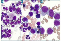 Which type of myeloid disorder?


 


Bone marrow