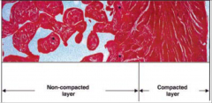 Isolated LV Non-compaction: Histology (* = areas of scarring).