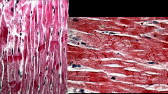 *Contraction band necrosis in stress cardiomyopathy.