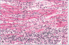 Histology of Lymphocytic myocarditis.