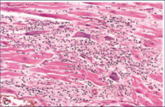 Giant cell myocarditis