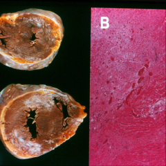 *Extensive scarring of LV myocardium involving anterior & posterior walls (A).
*Microscopic features of old fibrosis (B).