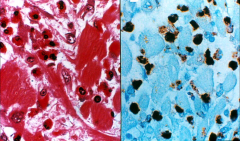 (A) Luna stain of eosinophil granules.
(B) Myeloperoxidase stain of myeloperoxidase-positive granules in cytoplasm of eosinophils & around degenerating myocytes.