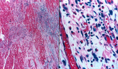 *Different stages of myocardial lesions:
(A)-focal cellular infiltrates w/ myocardial cell necrosis.
(B)-infiltrating cells were mainly eosinophils w/some lymphocytes.