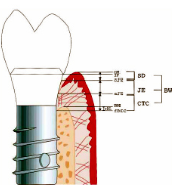   Single piece implants have a microgap placed
much higher up than two piece fixtures. 
-This is because the transmucosal component of
implant attached to fixture.  
                   