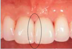 You're worried about formation of a black triangle because of the poor papilla fill between implants and implants. Your only choice is to have a long contact connector. 