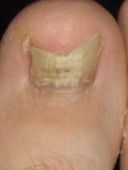 Fungal infection of the nail. It is the most common disease of the nails and constitutes about a half of all nail abnormalities. This condition may affect toenails or fingernails, but toenail infections are particularly common. The prevalence of o...