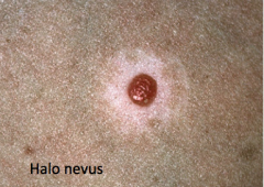 Small Bump, palpable lesion (<1cm)

Example:  Small Wart
