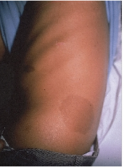 Large, flat discoloration (>2cm)

Example:  Bruise