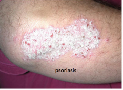 Large raised flat topped lesion, usually rough/scaly, greater than 2 cm

Lesion is greater in diameter than it is high; may be a bunch of nodules or papules

Example:  Psoriasis