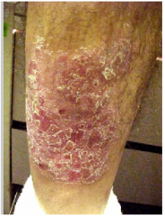 Roughness at surface; represents hyperkeratosis

Example:  Psoriasis