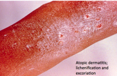 Leathery thickening with accentuated skin markings, often caused by chronically rubbed or scratched skin  

Example:  Chronically rubbed skin of eczema