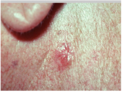 Dilated Capillaries visible through the skin surface 

Example:  Sun-damaged face
