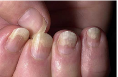 Separation of nail from bed 

Example:  Onchomysosis
