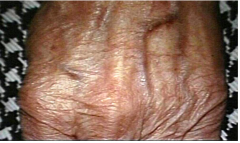Sunken thinned area of skin, microscopically shows loss of rete ridges in epidermis, occurs with age 

Example:  Corticosteroid induced.