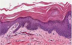 Thickening of stratum corneum w/o retained nuclei.