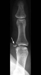 Creation of a Stener lesion, as found in Gamekeeper's thumb, requires combined tears of the proper and accessory ulnar collateral lig in order for the ligament to be displaced by the adductor aponeurosis. Which describes the role these ulnar colla...