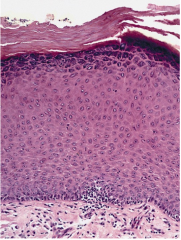 Thickening of epidermis (can sometimes be due to the increased prominence of granular layer).