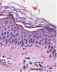 Intercellular edema -- between keratinocytes