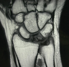 Hx:30yo F undergoes arthroscopy for a chronically painful R wrist that failed to improve w/4 mths of immobilization & NSAIDS, PE= revealed point tenderness dorsally over the lunate but no tenderness elsewhere in the wrist. on scope see a chondral ...