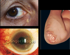 Top, right: Xanthomas.
Left, bottom: Arcus cornealis (yellow ring).

*Seen in familial hypercholesterolemia.