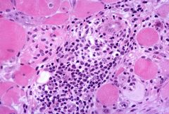 1. 

The pathology of dermatomyositis includes inflammation, vasculitis, and perifascicular atrophy. The inflammatory cells are predominantly B-cells (with smaller numbers of CD4-positive T-cells) and are found around blood vessels, in the sep...