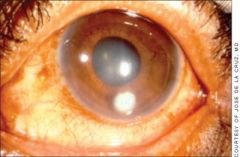 Bacterial keratitis — Bacterial infectious keratitis warrants evaluation by an ophthalmologist on the same day. The patient will complain of foreign body sensation and have trouble keeping the involved eye open, a sign of an active corneal proce...
