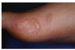 What type of tinea pedis is this? What do you see? Will it be itchy and painful? What type of hypersensitivity to dermatophyte?