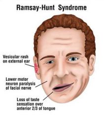 Ramsay Hunt syndrome is the result of post herpetic neuralgia
Involvment of of facila nerve and geniculate ganglion