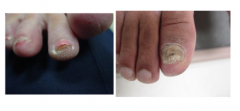 What type of onychomycosis? Proximal, distal, or superficial?