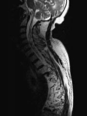 syringomyelia  
most common etiology of neuropathic shoulder arthropathy 
25% of these patients develop a neuropathic joint
monoarticular (shoulder > elbow)
Hansen's disease (leprosy)
second most common cause of neuropathic shoulder arthropat...