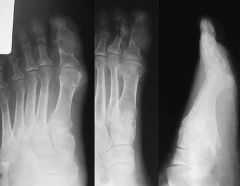 Gout is a disorder of, mn rembered tool