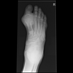 Which of the following foot radiographs is most consistent with the diagnosis of gout? ddx of gout & tx of, Mof Action
1 arthritis mutilans in psoriatic arthritis; 2 Freiberg's infraction; 3 Charcot foot; rheumatoid foot. tx