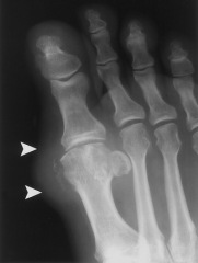 asymmetric polyarthropathy, well-defined erosions w/ sclerotic margins, overhnging bony edges, tophi.  well-defined punched out periarticular erosion w/sclerotic overhang'g borders w/in forefoot, consistent w/gout:: 
tx= indomethacin (indocin) 50...