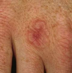 A 39-year-old man asks you to look at a skin lesion on the dorsum of his hand. It has been present for the past two years and has not changed recently.

What is the most likely diagnosis?