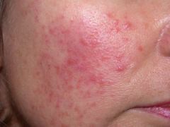 A 49-year-old woman complains of 'spots' on her cheeks. She has tried using her daughter's 'Clearasil' but this has had no effect. What is the most likely diagnosis?
