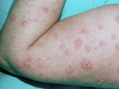 A middle aged man develops a non-pruritic rash after starting allopurinol therapy for gout. The rash develop within 24 hours and started on the back of his hands.What is the most likely diagnosis?