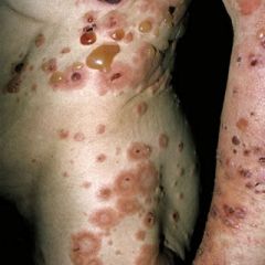 An elderly man develops a generalised pruritic rash:

Which one of the following is the mainstay of treatment?