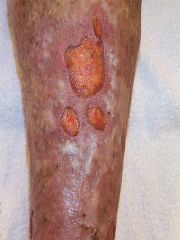You review an 82-year-old woman who has developed 'sores' on her legs. For the past two years she has had dry, itchy skin around her ankles but over the past few weeks the skin has started to break down. What is the most likely diagnosis?