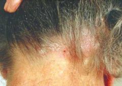 A 47-year-old woman complains of an itchy neck and scalp: This skin condition is though to occur as a result of a reaction to: