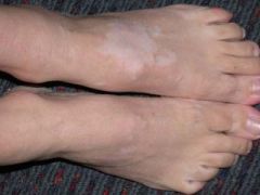 A 20-year-old woman presents after developing a white patch on her left foot:

Which one of the following statements regarding the diagnosis is correct?