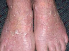 A 69-year-old woman asks you to have a look at her feet. She lives out in Spain most of the year but comes back to the UK periodically to see her family. She has similar changes on her forehead. The skin is not pruritc. What is the most likely dia...