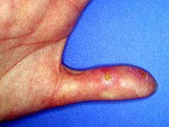 This patient is known to suffer from Raynaud's phenomenon: What does the lesion on her thumb most likely represent?