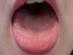 A 25-year-old woman asks you to look at her tongue. It has had this appearance for 'a few months' and she is asymptomatic. What is the most likely diagnosis?